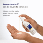 Effective Dandruff Control Lotion for Flake-Free Scalp